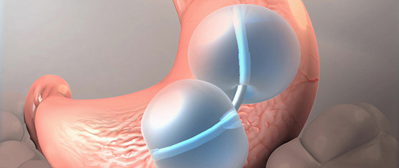 http://volohealthservices.com/uploads/ckfinder/images/mide-balonu.jpg