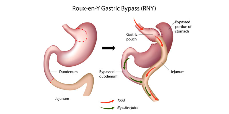 http://volohealthservices.com/uploads/ckfinder/images/roux-y-gastrik-by-pass.jpg